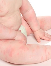 BABIES WITH HIVES