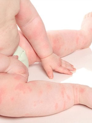 Baby with hives