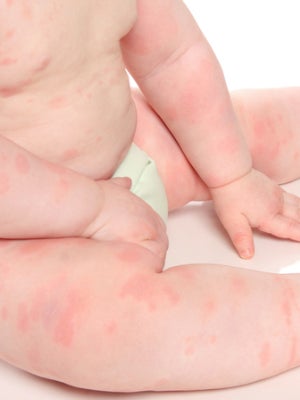 Babies With Hives Cma Symptom Nestle Health Science